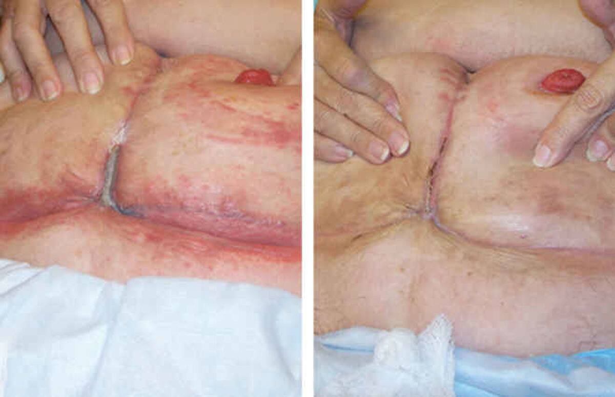 See how InterDry resolves skin fold complications