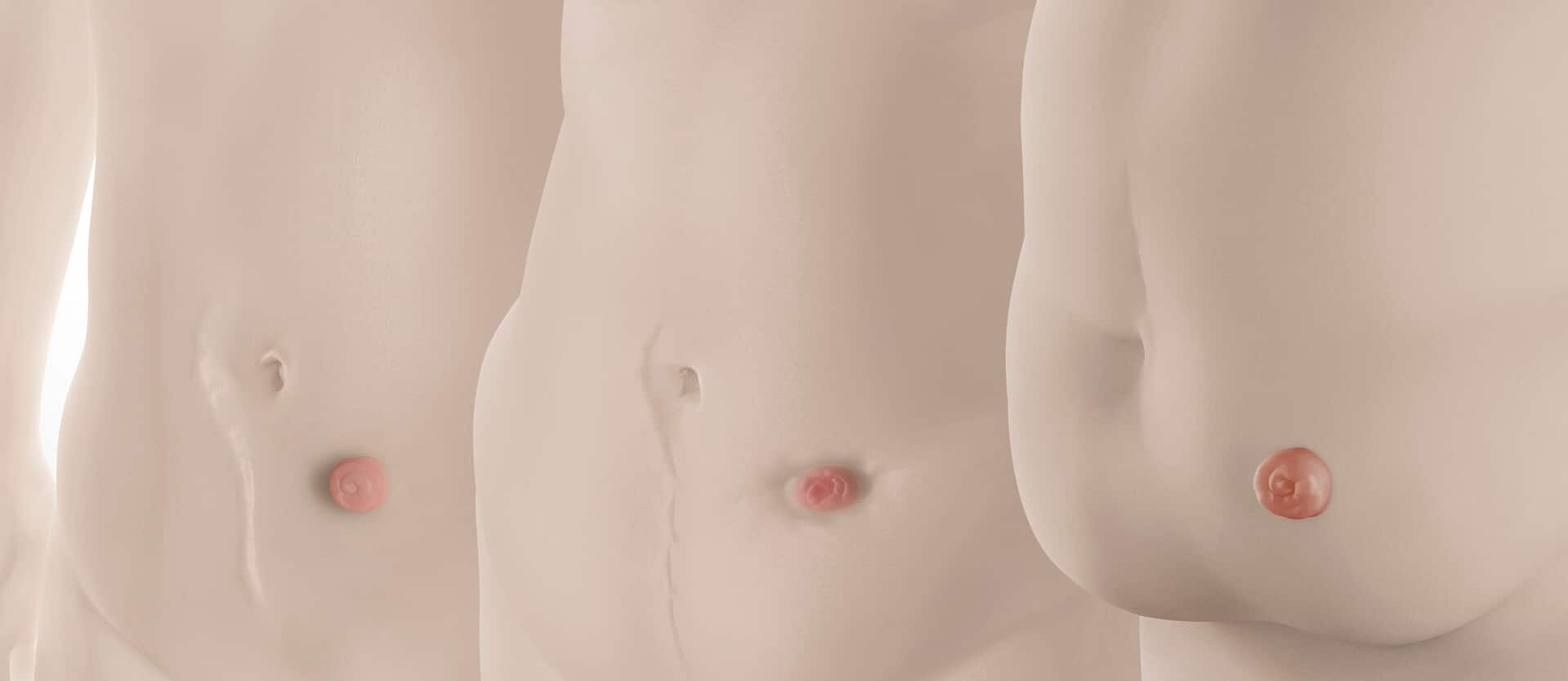 Peristomal body profile assessment tool