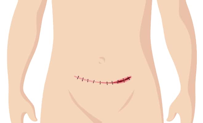 Pathway: Surgical Wound Dehiscence