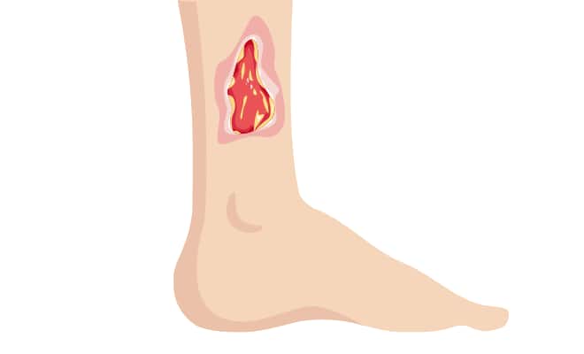 Pathway: Venous Leg Ulcer