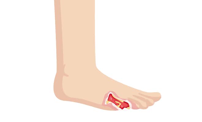 Pathway: Diabetic Foot Ulcer