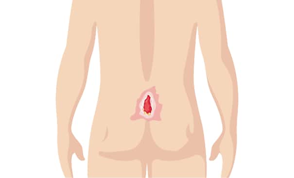 Pathway: Pressure Injury
